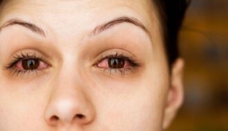 Bệnh khô mắt nguyên nhân và cách chữa trị cho dân văn phòng