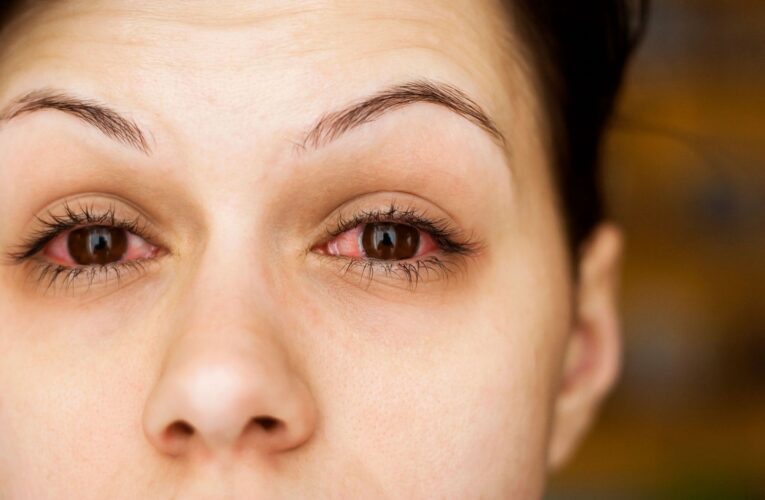 Bệnh khô mắt nguyên nhân và cách chữa trị cho dân văn phòng