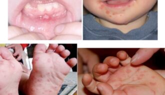 Bùng phát bệnh chân, tay, miệng ở trẻ em do đâu?