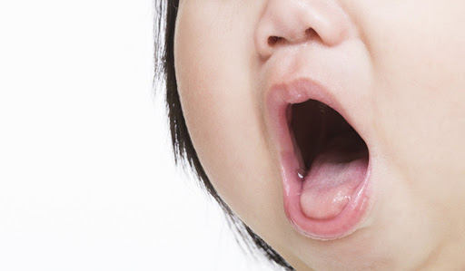 Viêm họng cấp tính là gì, có nguy hiểm không?