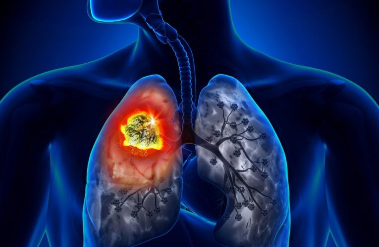 Dấu hiệu ung thư phổi – Đừng chủ quan nếu có dấu hiệu ho kéo dài